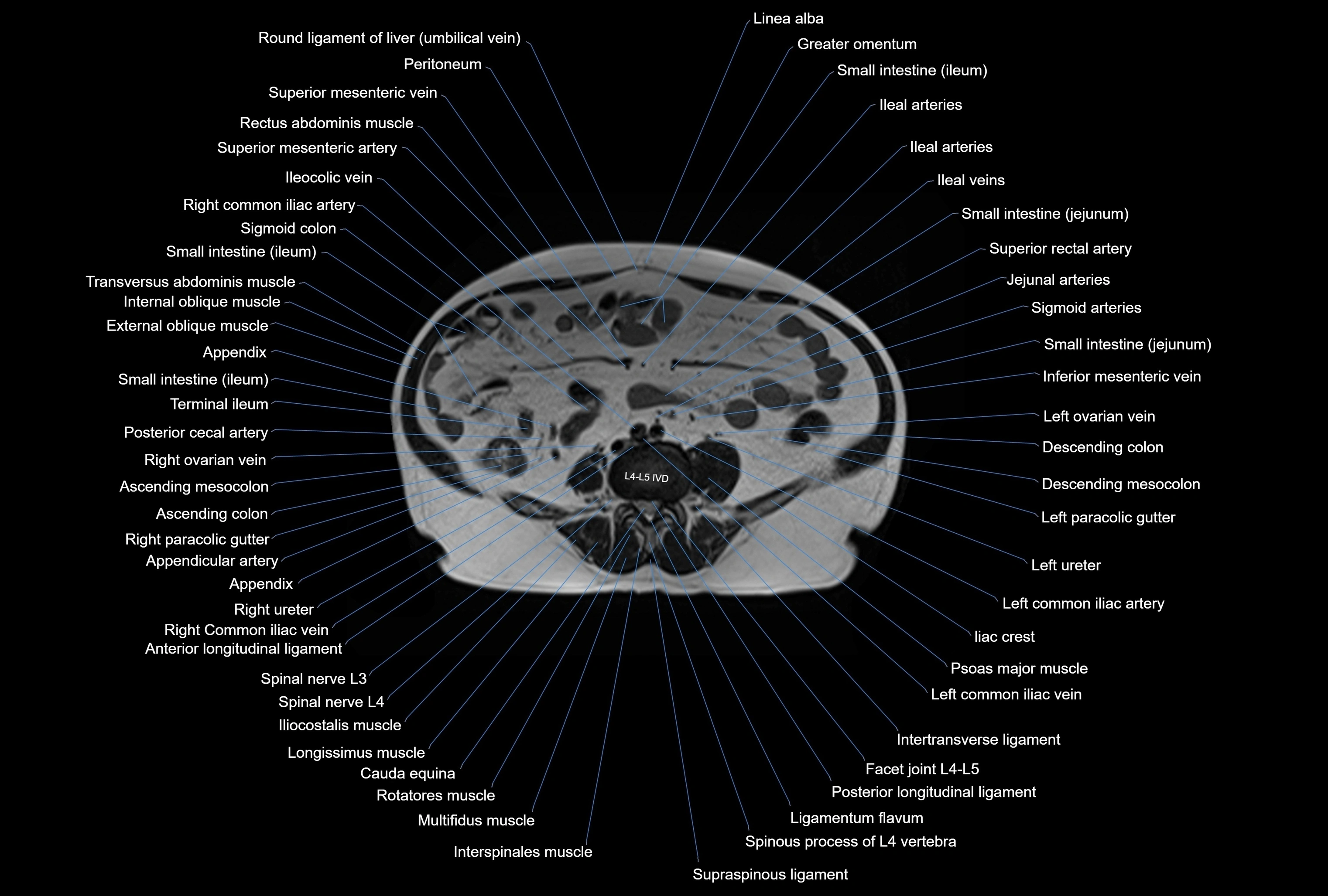 MRI Abdomen axial cross sectional anatomy radiology  image-img-00001-00033.webp